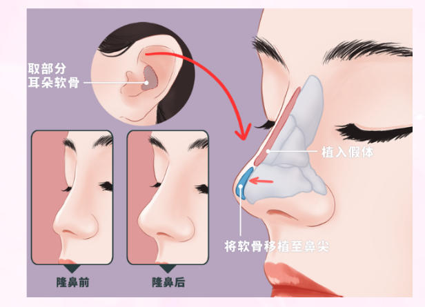 二、陈海彪医生的鼻综合整形技术特点