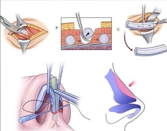 五、鼻整形常见问题解答