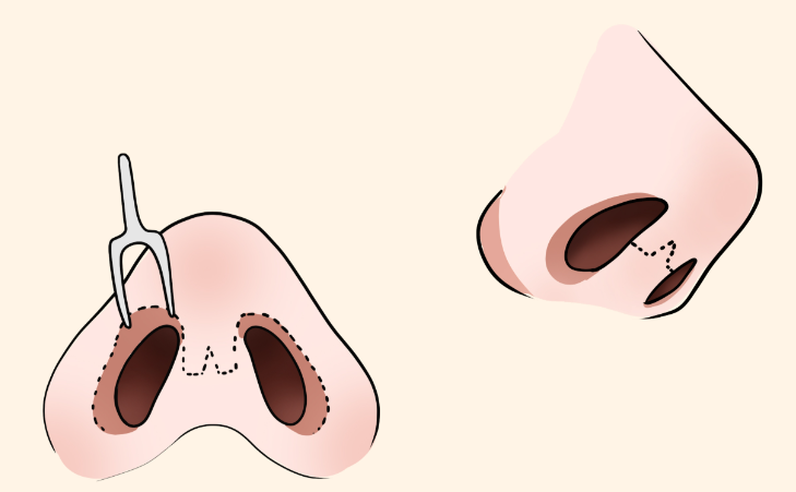 南京刘涛医生鼻整形技术特点与优势