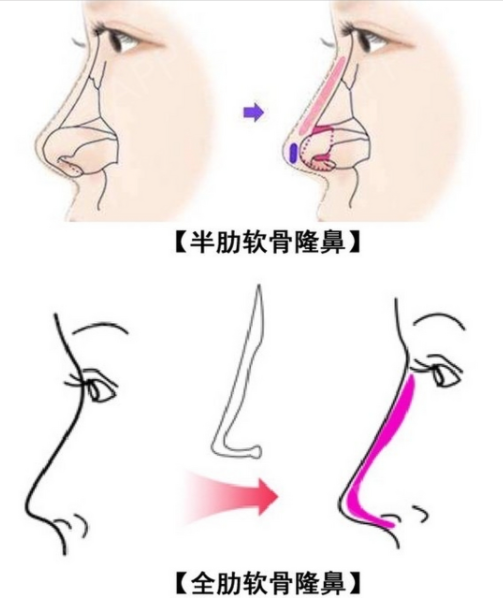 上海悅目佳容醫(yī)療鼻翼縮小多少錢？2025年價格參考：3000-5000元，楊杰醫(yī)生技術(shù)受好評