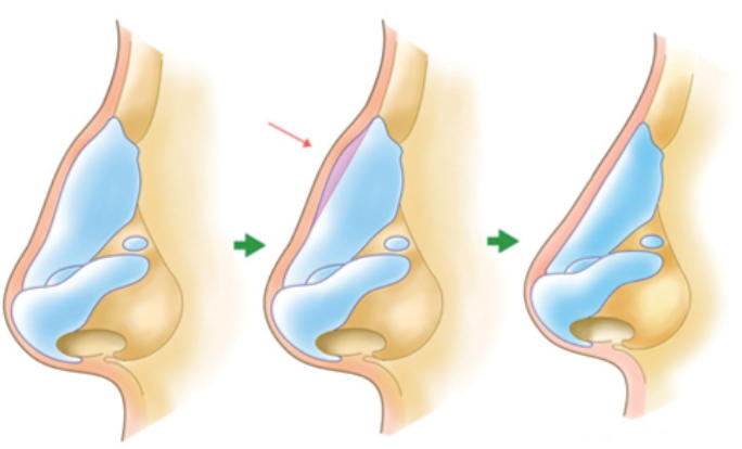 五、北京刘军鼻修复实例中的山根过高问题解决方案