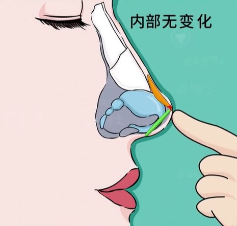 上海马金荣隆鼻实例分享！鼻额角衔接自然，风格适配度高