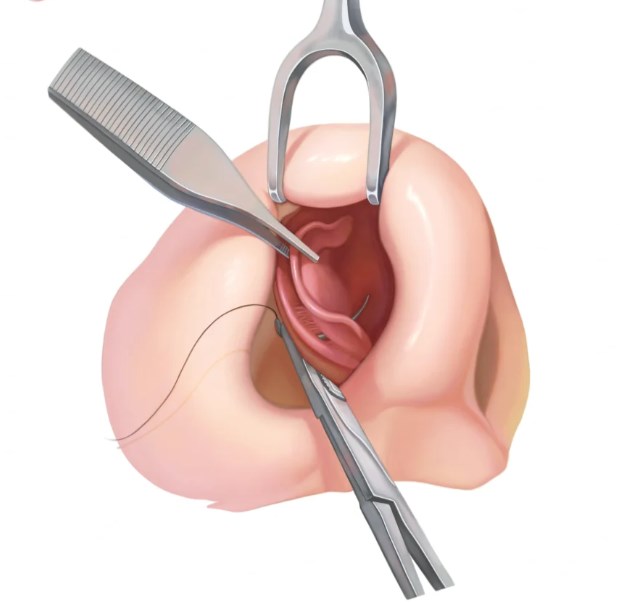 上海杨杰鼻整形技术特点：4个“让求美者放心”的细节