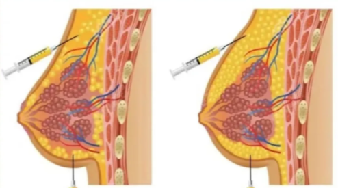 薇庭美注射豐胸怎么樣？50位素人真實(shí)案例揭秘，3年效果對(duì)比及風(fēng)險(xiǎn)解析