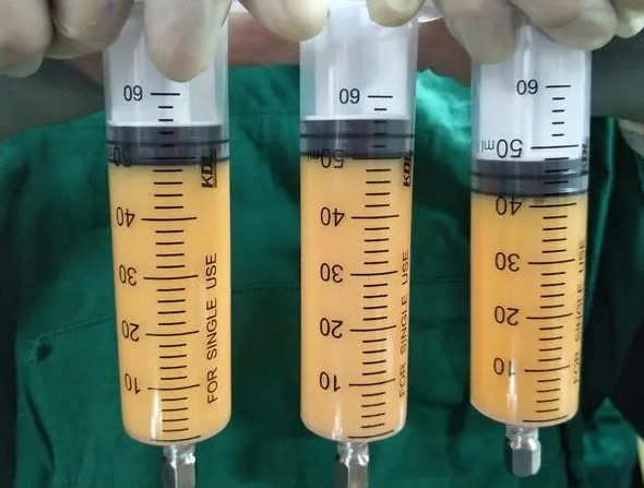 二、曹卫刚自体脂肪填充的技术优势解析