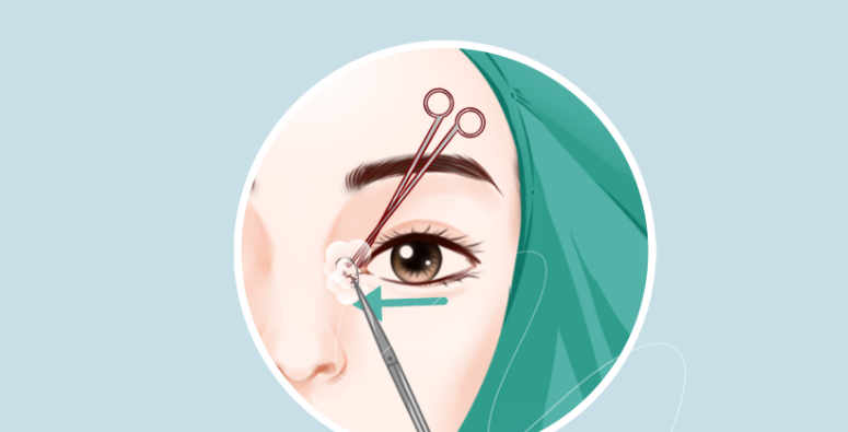 2026年北京魏志香内眼角修复不需要避雷！技术比你想的更靠谱，20年经验揭秘术后零痕真相，4.8万高难度修复值