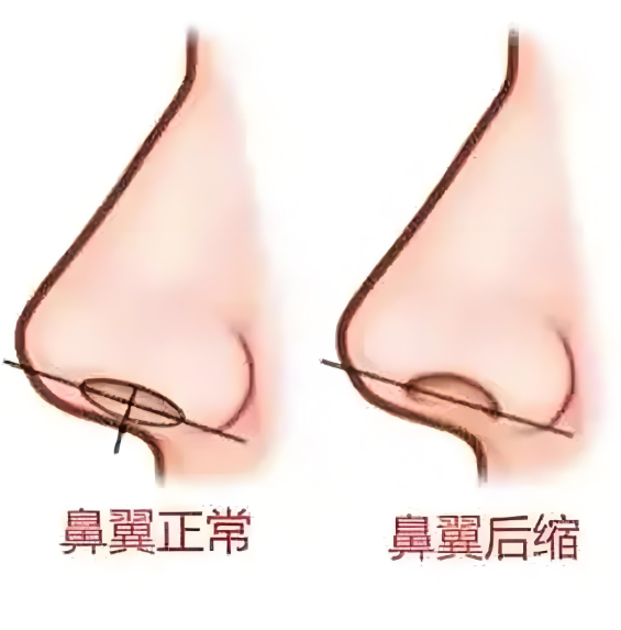 长沙艺星秦晓东缩鼻翼价格曝光，轻度鼻翼肥大缩小12,800起，收费透明