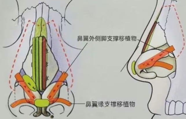 三、关于长沙艺星秦晓东缩鼻翼价格的常见疑问解答