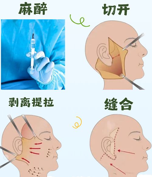 一、深度剖析:长沙罗亮医生的小切口拉皮技术究竟如何?