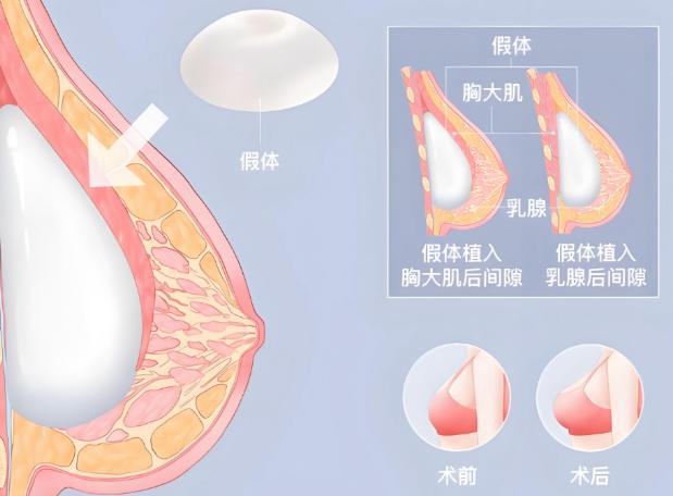 成都隆胸大佬医生推荐谁最靠谱？假体脂肪怎么选不踩坑，刘勇薛瑞技术天花板对比测评