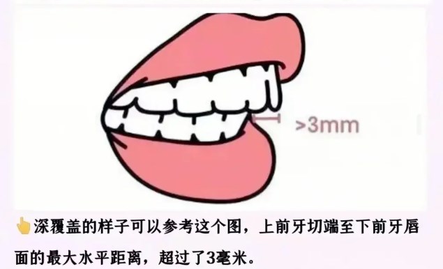 三、青少年错颌畸形矫正实战指南