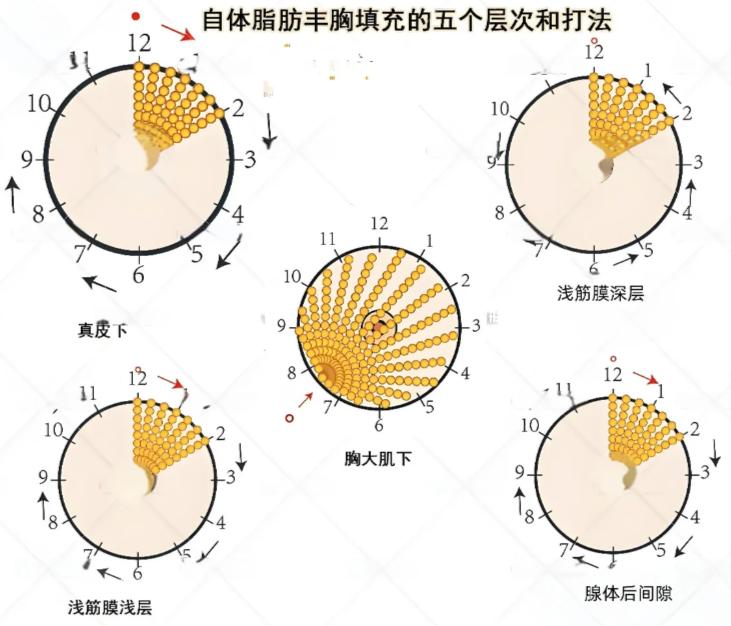 深入剖析:泉州本地人常去的隆胸医院详情
