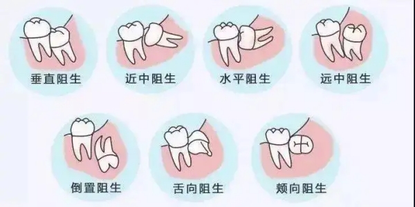二、拔烂牙一般多少钱，到底由哪些因素决定？