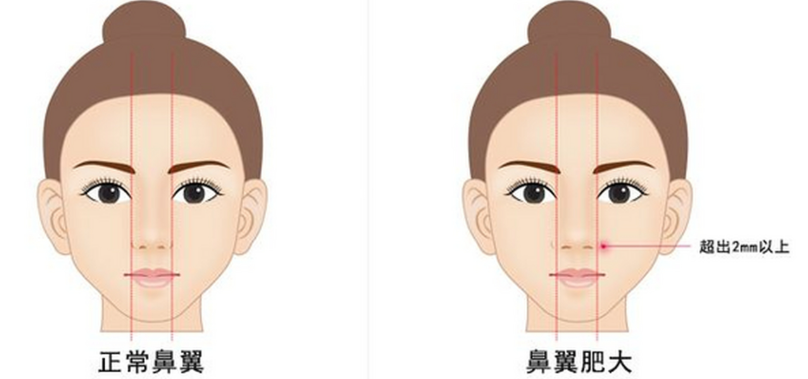 南京陈刚整形医生做鼻子技术自然风，价格透明，适合初鼻，恢复快