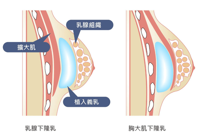四、 长沙祺美医疗美容医院隆胸安全吗？材料是底线：假体扫码验真材料放心吗？