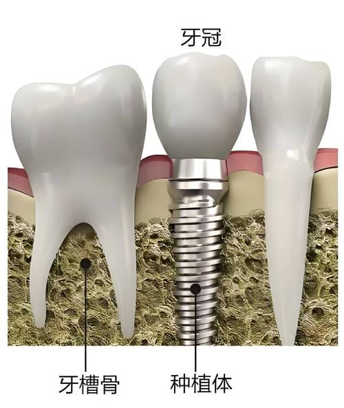 福州福清德恒口腔价格2026年贵吗？种牙2980元起、矫正8980元起，收费透明！